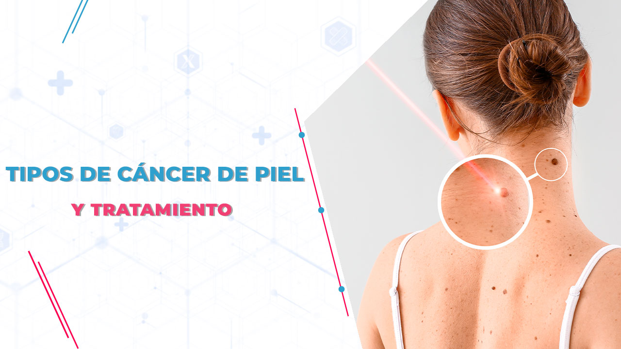 cáncer de piel